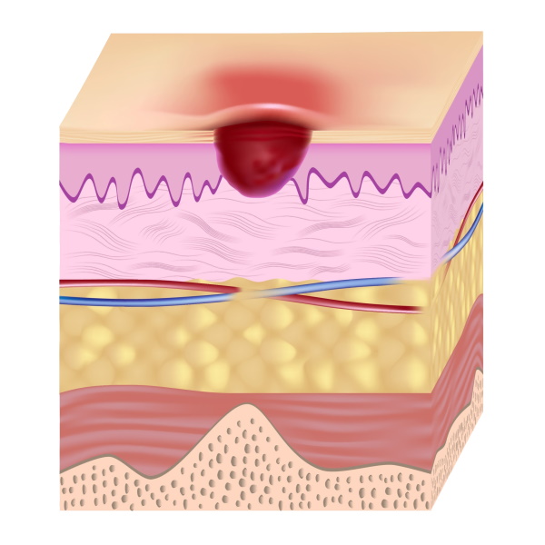 Pressure ulcer treatment